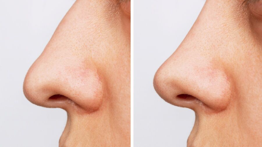 What Is “Preservation Rhinoplasty” and Why Does It Work