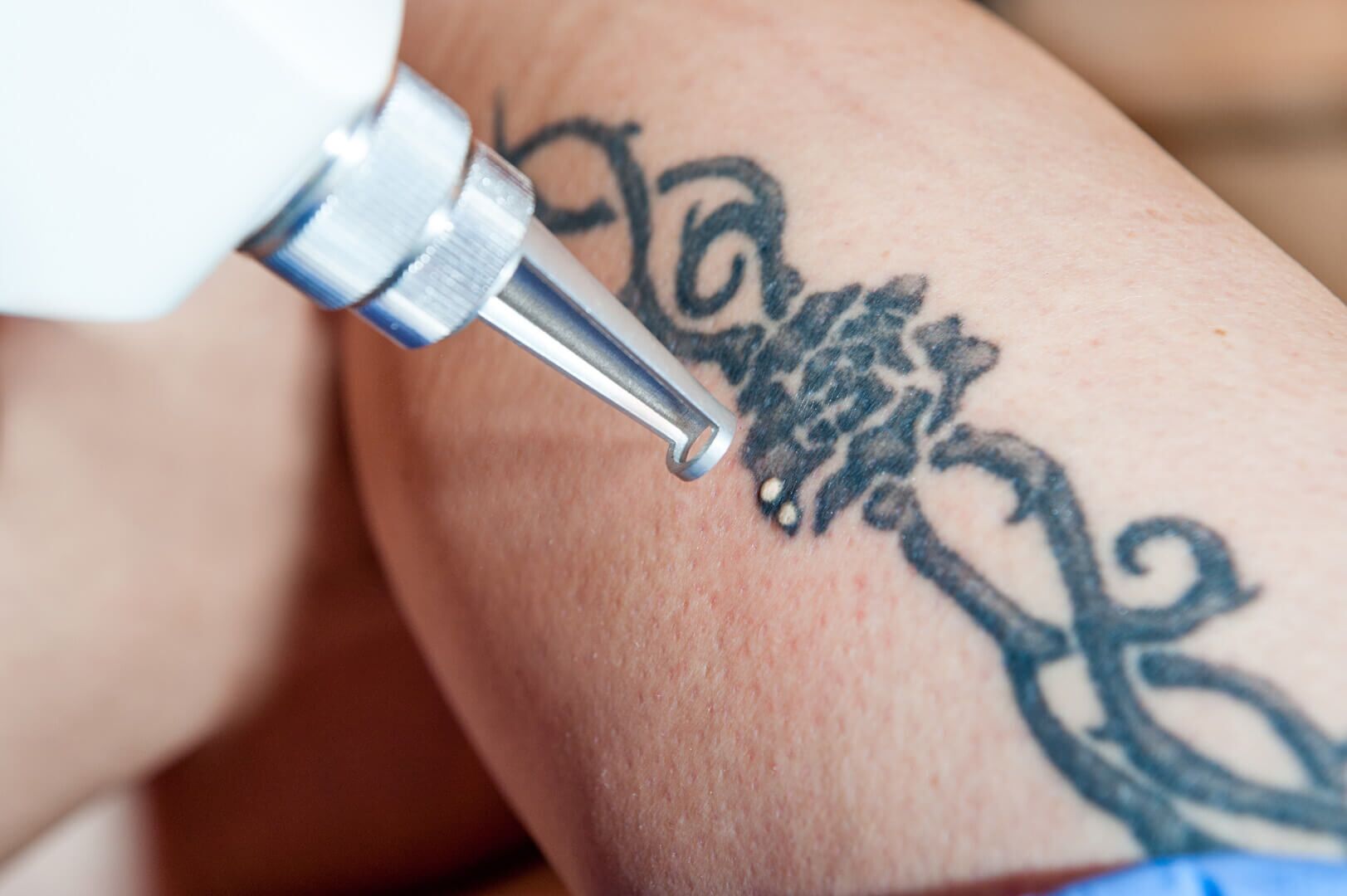 Best Tattoo removal treatment in Indore ✨ . . . . . Read more -  https://drmeetsclinic.in/regret-no-more-indores-trusted-tattoo-removal-...  | Instagram